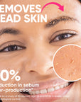ame pure peels so good, chemical peeling, chemical peel, aha, bha, fruit a cid, smooth skin peelilng, enyzme scrub, oily skin, acne removal