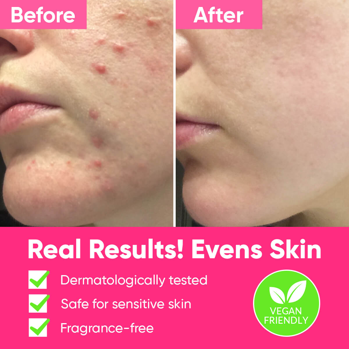 ame pure peels so good, chemical peeling, chemical peel,  aha, bha, fruit a cid, smooth skin peelilng, enyzme scrub, oily skin, acne removal