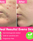 ame pure peels so good, chemical peeling, chemical peel, aha, bha, fruit a cid, smooth skin peelilng, enyzme scrub, oily skin, acne removal
