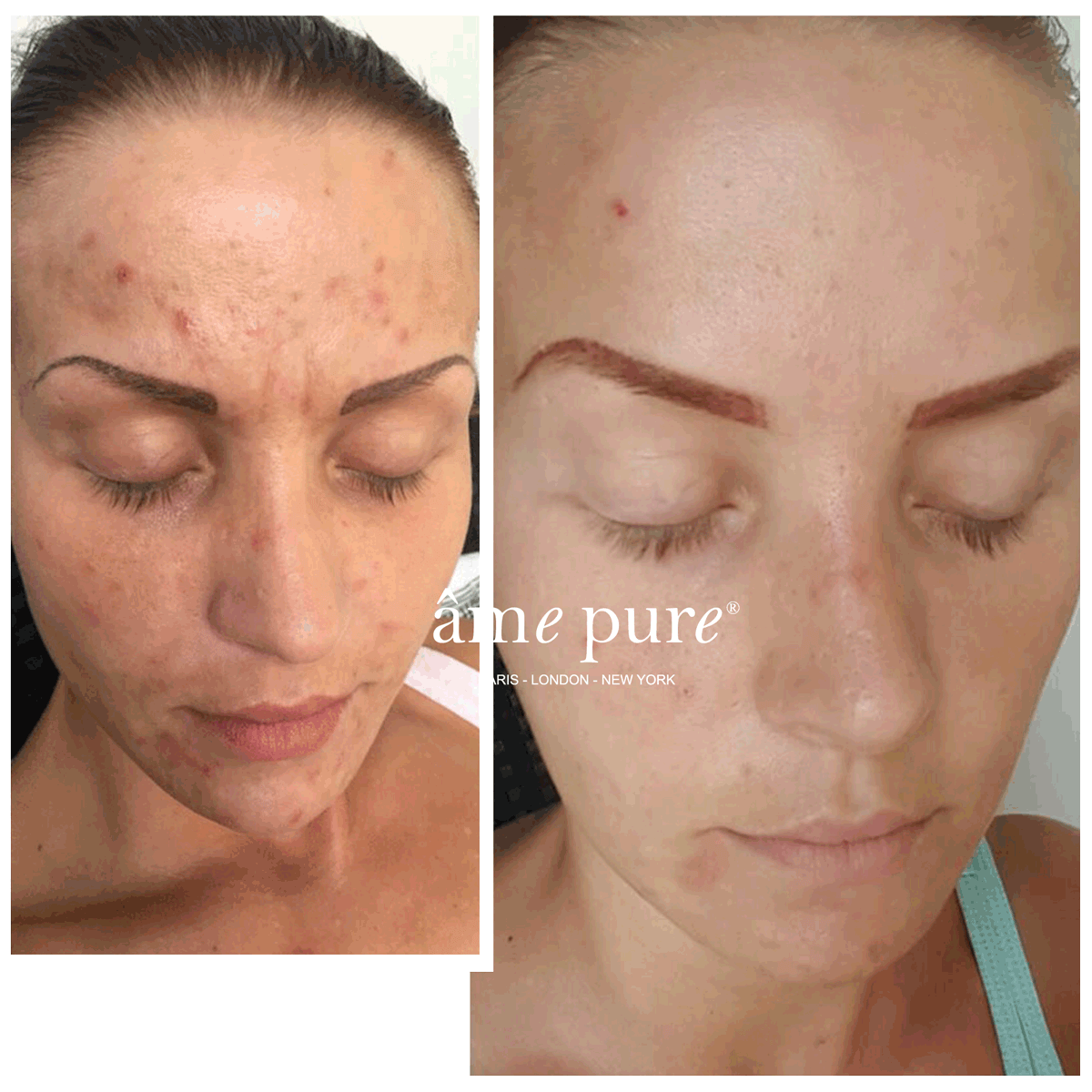 CIT Face Roller PLATINUM