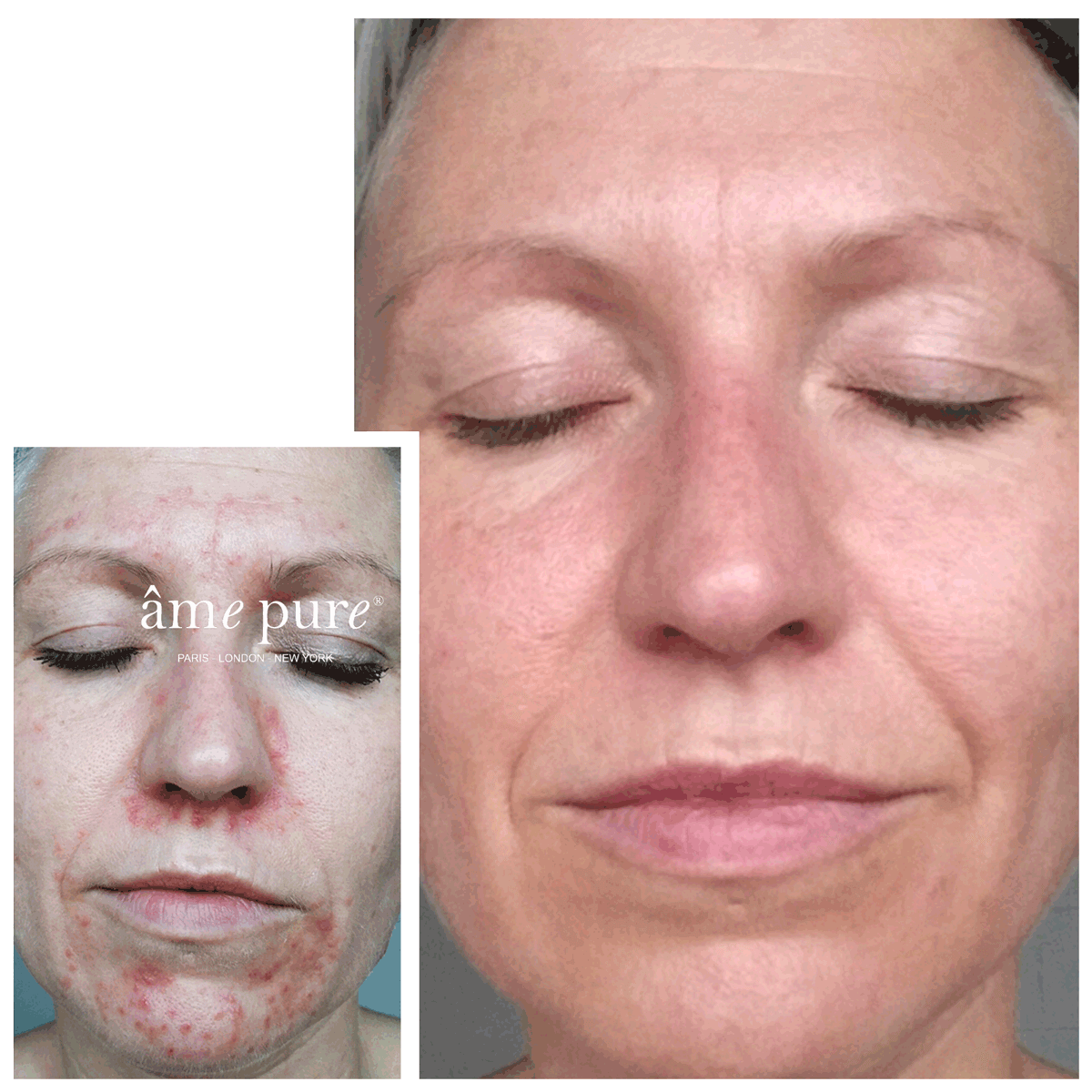 CIT Face Roller PLATINUM