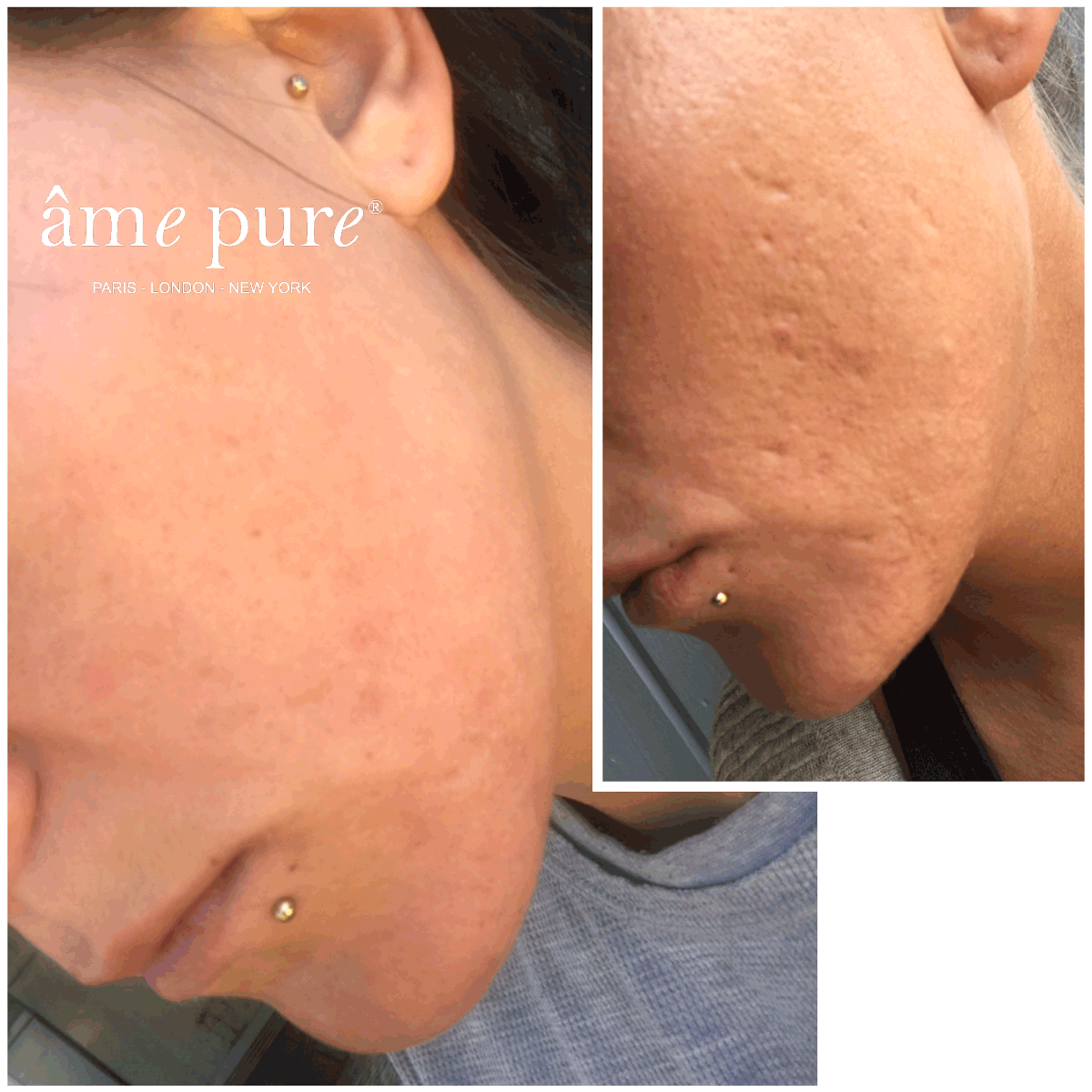 CIT Face Roller PLATINUM