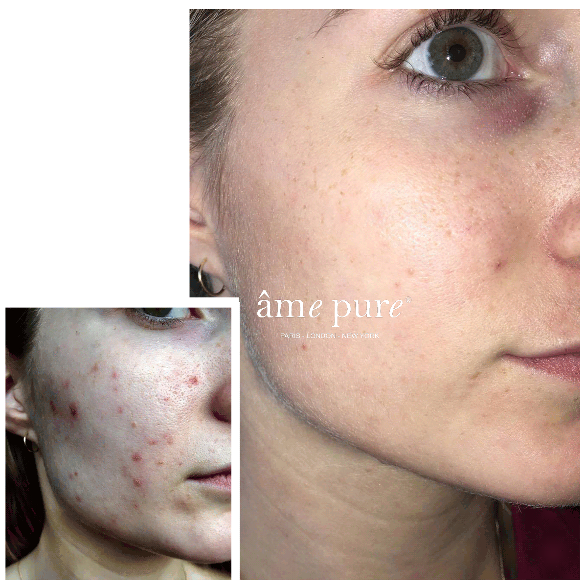 CIT Face Roller PLATINUM