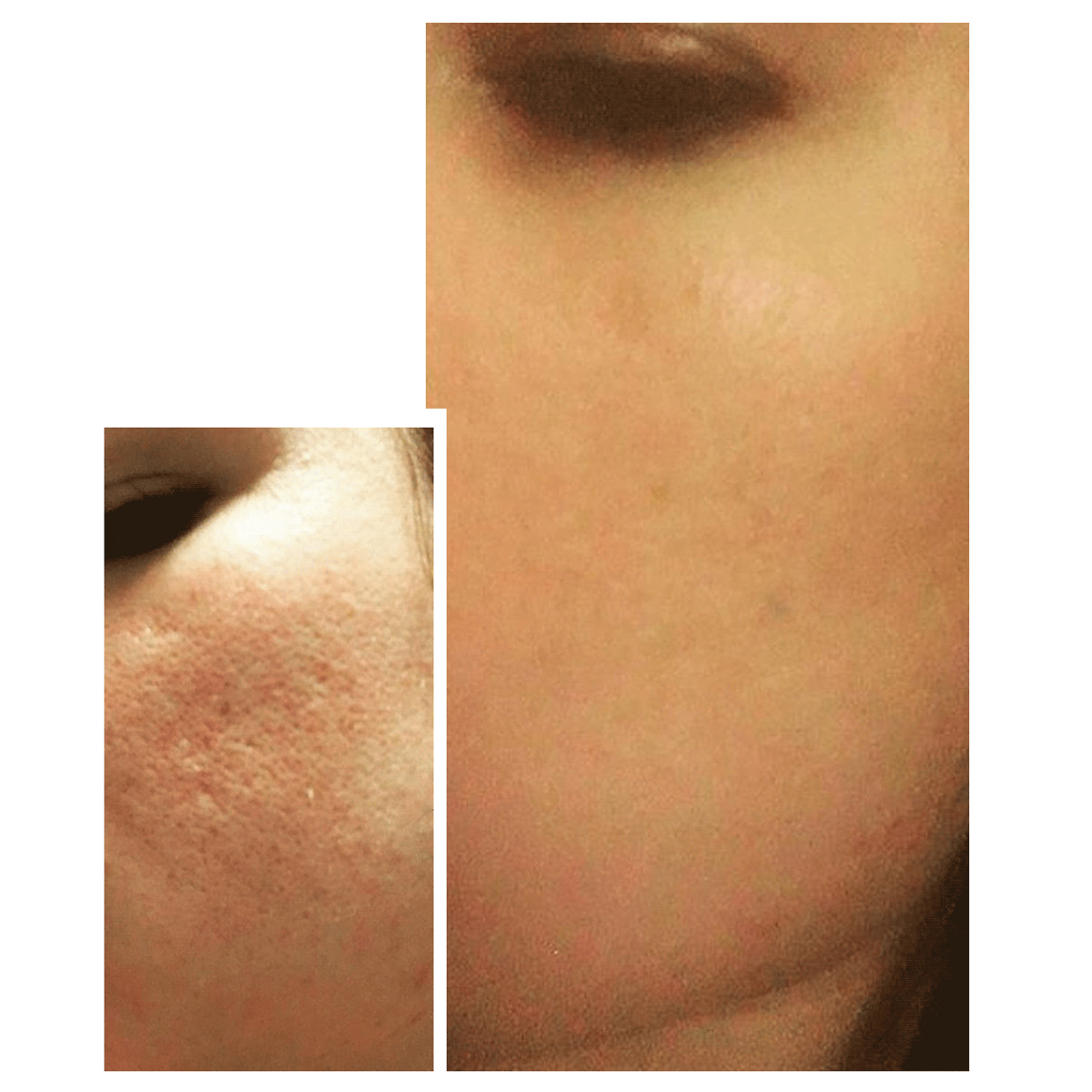 CIT Face Roller PLATINUM