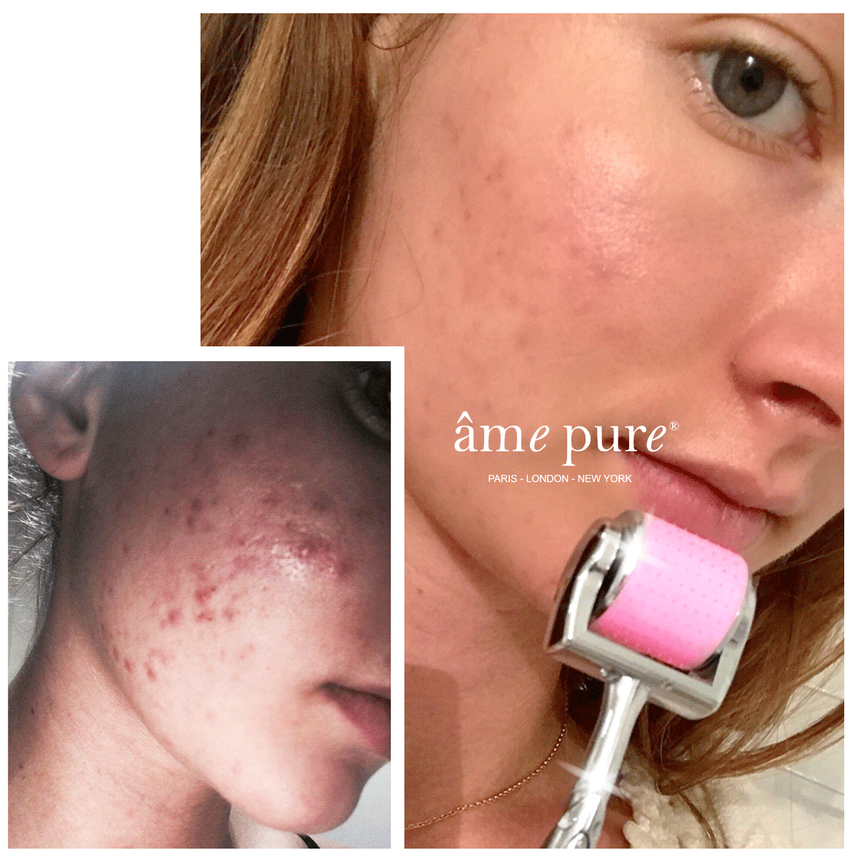 CIT Face Roller PLATINUM