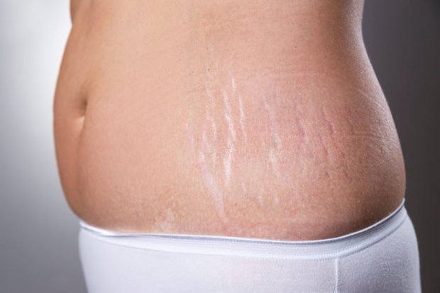 Get Rid Of Stretch Marks For A Flawless Summer Body
