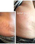 Body Basic | Stretch Marks - Buy 1 Get 1 Free